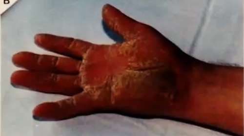 Τα δύο χαρακτηριστικά γνωρίσματα που δείχνουν ότι κάποιος μπορεί να έχει τη νόσο της Νάξου