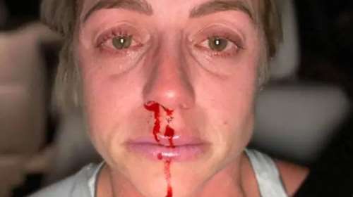 Σοκ - Γυναίκες δείχνουν το μελανιασμένο πρόσωπό τους από την κακοποίηση στην καραντίνα του κορονοϊού [εικόνες]