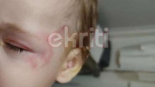 Κρήτη: Στο ΠΑΓΝΗ το βρέφος που δάγκωσε λυκόσκυλο - Φέρει τραύματα σε πρόσωπο και σώμα [εικόνες]