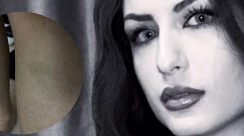 Βιασμός 24χρονης στη Θεσσαλονίκη: Φωτογραφίες σοκ με τους μώλωπες στο σώμα της Γεωργίας