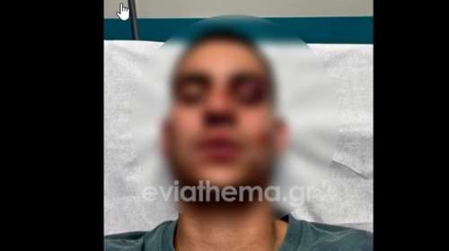 &quot;Μιλάμε για απόπειρα ανθρωποκτονίας&quot; - Τι αποκαλύπτει ο πατέρας του 19χρονου που ξυλοκοπήθηκε στη Χαλκίδα για ένα like