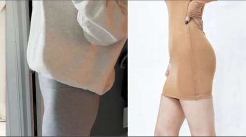 ΗΠΑ: Χάνουν βάρος με Ozempic και μετά φτιάχνουν γλουτούς με ενέσεις λίπους από πτώματα - Για το τέλειο σώμα