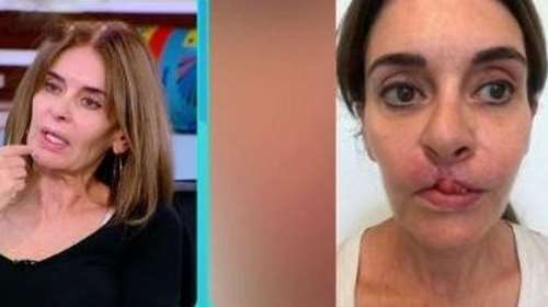 Συγκλονίζει η Κατερίνα Πλουμιδάκη: &quot;Στις 40 εγχειρήσεις θα είμαι καλύτερα&quot; - Όσα αποκάλυψε η συγγραφέας για τις επεμβάσεις στα χείλη