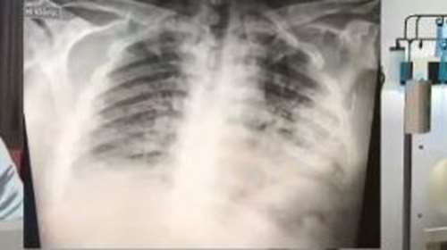 Σοκαριστικό: Έτσι είναι οι πνεύμονες ενός ασθενούς με κορονοϊό [Βίντεο]