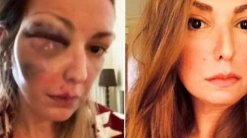 Σοκάρει γνωστή Ελληνίδα food blogger: Έπεσε θύμα κακοποίησης - Δημοσίευσε φωτογραφίες μετά τον ξυλοδαρμό