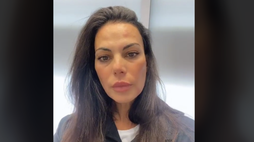 Εύη Βατίδου: Δείχνει τα σημάδια από το μπότοξ στο πρόσωπό της - "Είναι σαν με τσίμπησε σκνίπα"