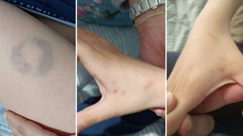 Διευθύντρια σχολείου δάγκωσε 11χρονο μαθητή στην Άρτα – &quot;Ήμουν σε άμυνα&quot;, είπε στη μητέρα