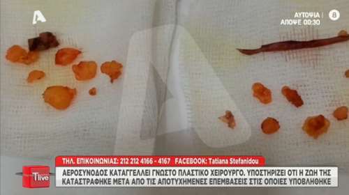 Φωτογραφία - ντοκουμέντο: Τα κομμάτια λίπους που έβαλε ο γνωστός πλαστικός χειρουργός στην αεροσυνοδό και την παραμόρφωσε