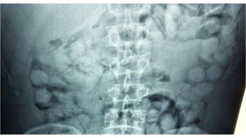 &quot;Ελ. Βενιζέλος&quot;: Συνελήφθη Βραζιλιάνος που είχε καταπιεί 100 &quot;αυγουλάκια&quot; κοκαΐνης