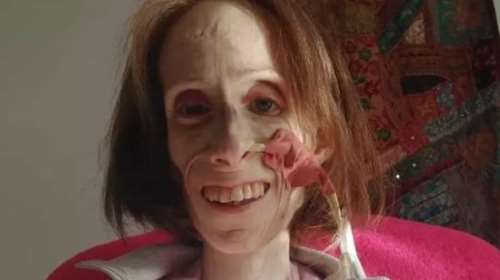 Σοκ: Ζυγίζει λιγότερο από 20 κιλά και κινδυνεύει να πεθάνει 36χρονη Βρετανίδα από σοβαρό λάθος των γιατρών