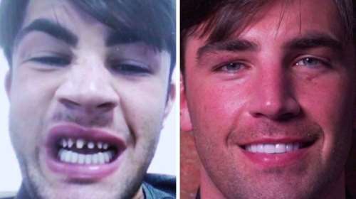 #Turkeyteeth: Βρετανοί πηγαίνουν στην Τουρκία για να φτιάξουν τα δόντια τους και γυρνάνε με φριχτούς πόνους