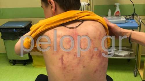 Πάτρα: Καταδίκη μαθητών για ξυλοδαρμό ΑΜεΑ – Τι λένε οι γονείς του