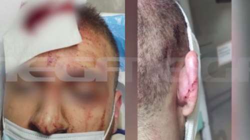 Ατύχημα στο Allou Fun Park: Φωτογραφίες σοκ από τα τραύματα στο κεφάλι του 25χρονου - &quot;Δεν ήμασταν όρθιοι&quot; [Εικόνες - Βίντεο]