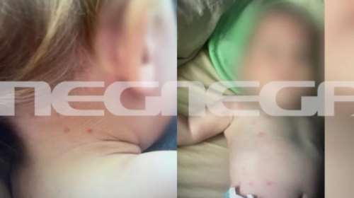 Καβάλα: Φωτογραφίες σοκ - Τα τσιμπήματα από ψύλλους στο κορμάκι του μωρού που σκότωσε ο 56χρονος