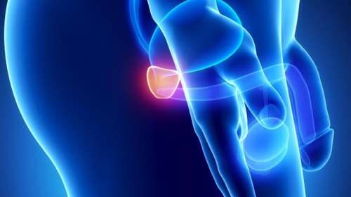 Οι άνδρες με καρκίνο του προστάτη έχουν πολύ μεγαλύτερο κίνδυνο για σοβαρές θρομβώσεις στο αίμα