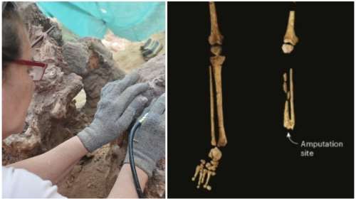 Ανακάλυψη: To πρώτο χειρουργείο έγινε πριν 30.000 χρόνια στην Ινδονησία και ο ασθενής επέζησε