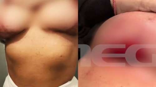 Σε απόγνωση 30χρονη - Πλαστικός χειρουργός τετραγώνισε το στήθος της - &quot;Σαν να με έχει σφάξει χασάπης&quot; [βίντεο]