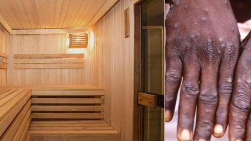 Ευλογιά των πιθήκων: Αυξάνονται ανησυχητικά τα κρούσματα στην Ευρώπη - Σάρωσε σε σάουνα ενηλίκων στην Ισπανία