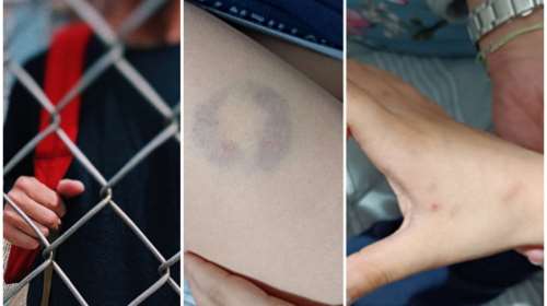 Άρτα: Παρέμβαση του υπ. Παιδείας για το απίστευτο περιστατικό - Διευθύντρια σχολείου δάγκωσε 11χρονο μαθητή ΑμεΑ
