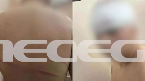 Θεσσαλονίκη: Ξεσπά ο πατέρας του 13χρονου - &quot;Λείπει κομμάτι από το κεφάλι του - Είναι γεμάτος τρύπες 15 πόντων&quot; [βίντεο]