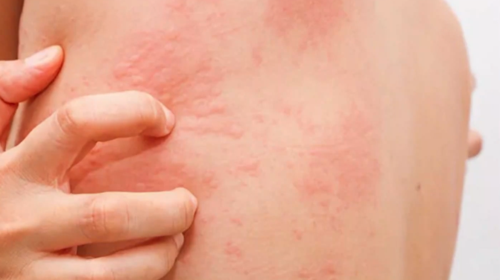 Μετάλλαξη Όμικρον: Αυτά είναι τα δερματικά συμπτώματα που προκαλεί - Πόσοι τα εμφανίζουν [Βίντεο]