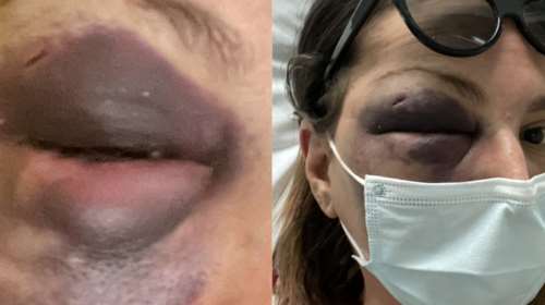 Στεφανία Τζαφέρη: Μυστήριο με την κακοποίηση της food blogger από την Κρήτη - Νέες σοκαριστικές εικόνες