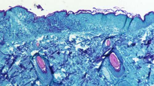 Δεύτερο κρούσμα ευλογιάς των πιθήκων: Κάθε Πέμπτη πλέον επίσημη ενημέρωση από τον ΕΟΔΥ