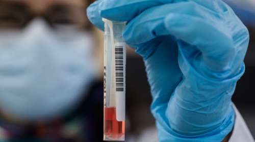 Πρόεδρος Παιδιάτρων για οξεία ηπατίτιδα: Πιθανόν οφείλεται σε αδενοϊό σε συνδυασμό με κορονοϊό