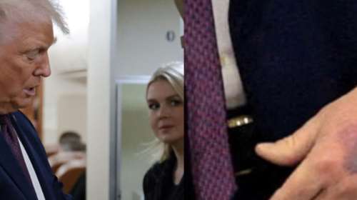 Τι συμβαίνει με την υγεία του Τραμπ: Η μελανιά στο χέρι του και η εξήγηση στους δημοσιογράφους [βίντεο]