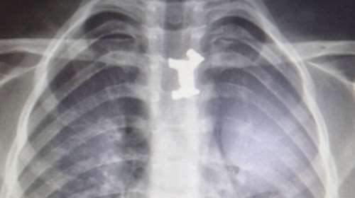 Αγοράκι κατάπιε μεταλλικό σκυλάκι -  Σωτήρια επέμβαση στο Ιπποκράτειο