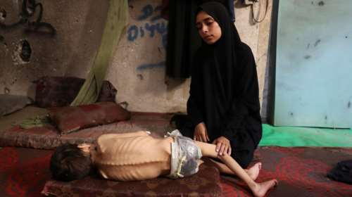 Διευκρινίσεις από τους New York Times: Ο υποσιτισμένος μικρός Μοχάμεντ από τη Γάζα &quot;έχει και άλλη πάθηση&quot;