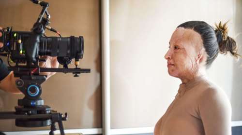 Ιωάννα Παλιοσπύρου: Το έγκαυμά της ίσως είναι το μεγαλύτερο παγκοσμίως, λέει η γιατρός της