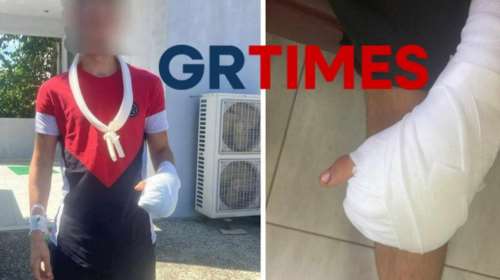 Θεσσαλονίκη: Ανήλικος έχασε τα 4 δάκτυλά του σε ξυλουργείο - &quot;Εγκληματική αμέλεια εργοδότη&quot; καταγγέλλουν οι γονείς του