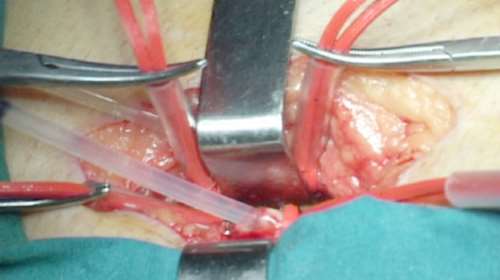 Εξοργιστικό: Γιατροί ξέχασαν στην κοιλιά ασθενούς σπάτουλα - Αποζημίωση 64.500 ευρώ στην άτυχη γυναίκα