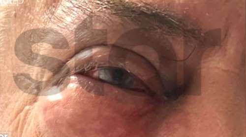 Γλυφάδα: Επιχειρηματίας κατήγγειλε ξυλοδαρμό από πρώην συνέταιρό του μέσα σε εστιατόριο