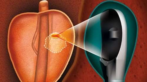 &quot;Θερίζει&quot; ο καρκίνος του προστάτη: Πρώτος σε συχνότητα στη χώρα μας και τρίτος στην Ευρώπη