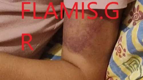 Πάτρα: Θύμα κακοποίησης 16χρονη από τον 25χρονο φίλο της - Η καταγγελία της μητέρας της