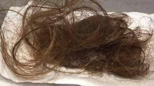 &quot;Αυτό αντίκρυσα όταν πήγα να χτενιστώ&quot;: Συγκλονίζουν οι μαρτυρίες ασθενών με long covid