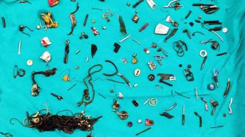 Ινδία: 35χρονος είχε καταπιεί από κουμπιά μέχρι κλειδαριές - Οι γιατροί αφαίρεσαν 60 αντικείμενα από το στομάχι του