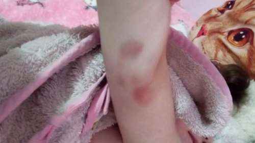 Πάτρα: Φωτογραφία-ντοκουμέντο - Οι μελανιές στο χέρι της 9χρονης Τζωρτζίνας - Πώς έγιναν [βίντεο]