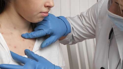 Εντονη ανησυχία για την ανοδική τάση της ιλαράς – Τα στοιχεία για την Ελλάδα, πότε γίνονται τα εμβόλια