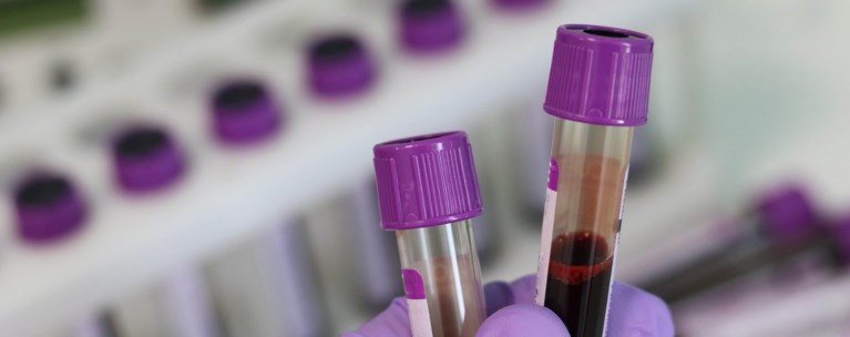 Εξέταση αίματος θα ανιχνεύει τον καρκίνο του μαστού 5 χρόνια πριν