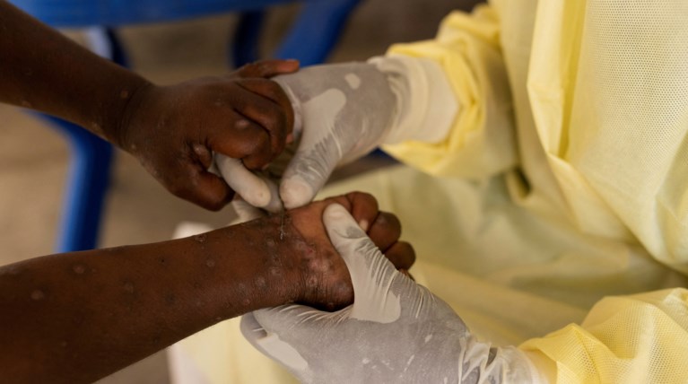 HEALTH-MPOX