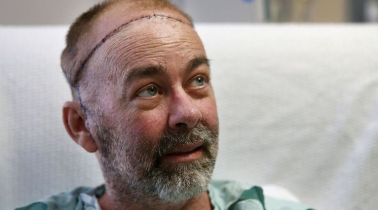 Η πρώτη μερική μεταμόσχευση κρανίου έγινε στο Τέξας