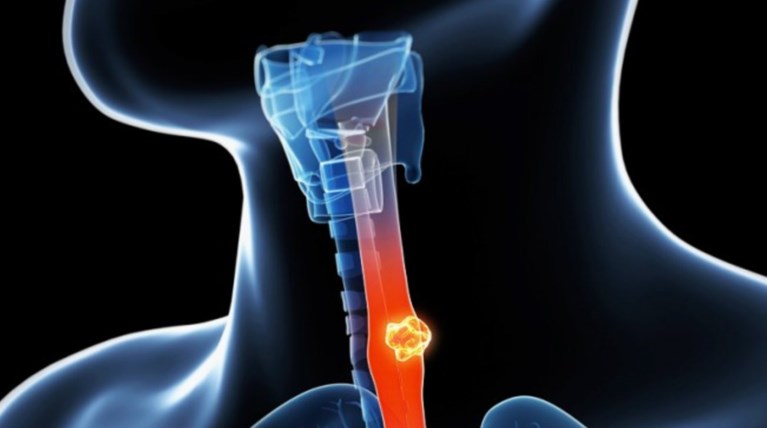 Τεστ "βλέπει" μορφή καρκίνου 10 χρόνια πριν εκδηλωθεί