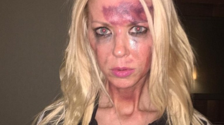 Ηθοποιός κακοποιημένη και μελανιασμένη στο instagram - Τι συνέβη;