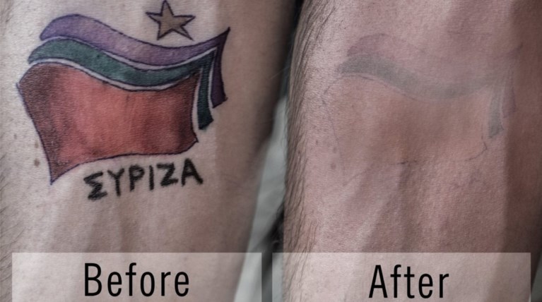 Είχε «χτυπήσει» τατουάζ με το λογότυπο του ΣΥΡΙΖΑ και το αφαίρεσε