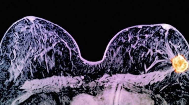 Συνδυασμός φαρμάκων εξαφάνισε καρκινικούς όγκους σε 11 μέρες