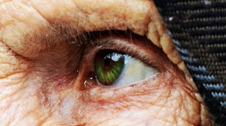 Η πρώτη γονιδιακή θεραπεία για την εκφύλιση της ωχράς κηλίδας