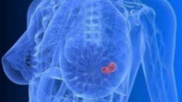 Βάζουμε «Στόχο» την πρόληψη με δωρεάν έλεγχο μαστού στο μετρό Συντάγματος